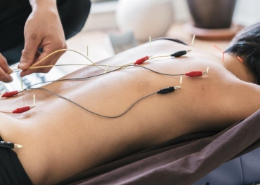 Acupuncture with electrical stimulation